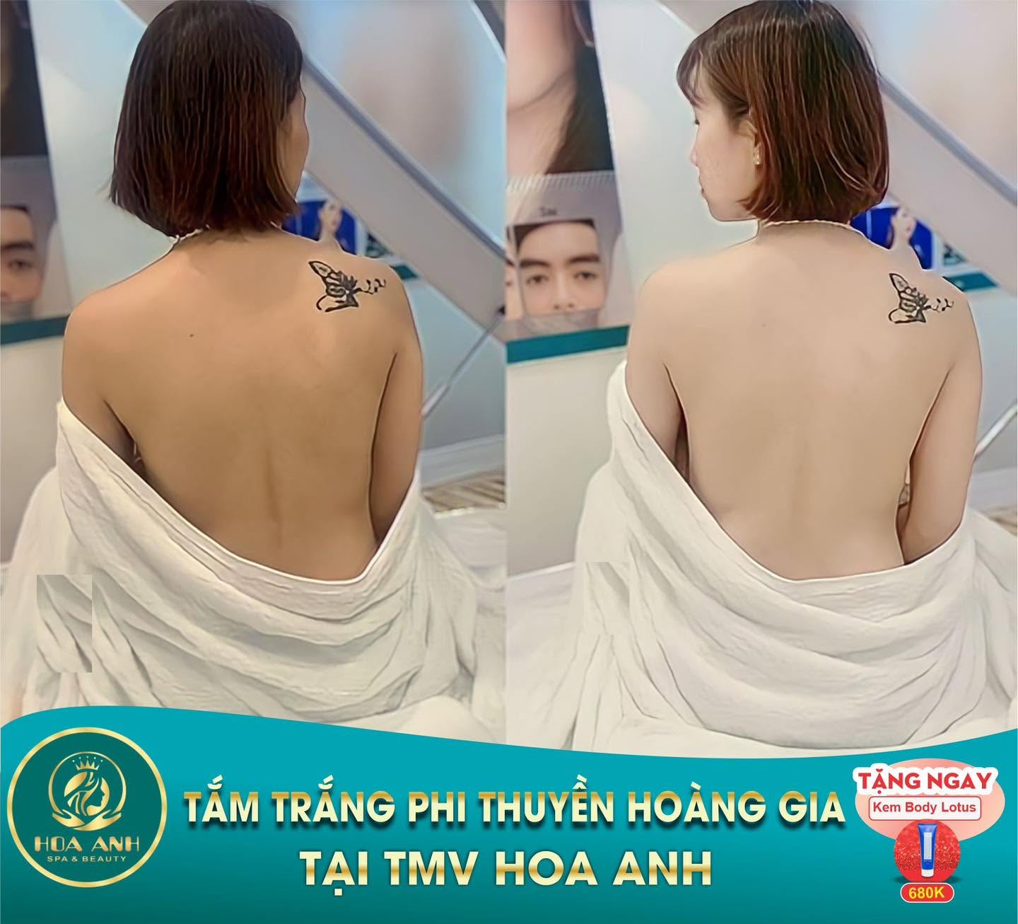 Trước và sau tắm trắng Phi Thuyền Hoàng Gia vùng lưng tại Hoa Anh